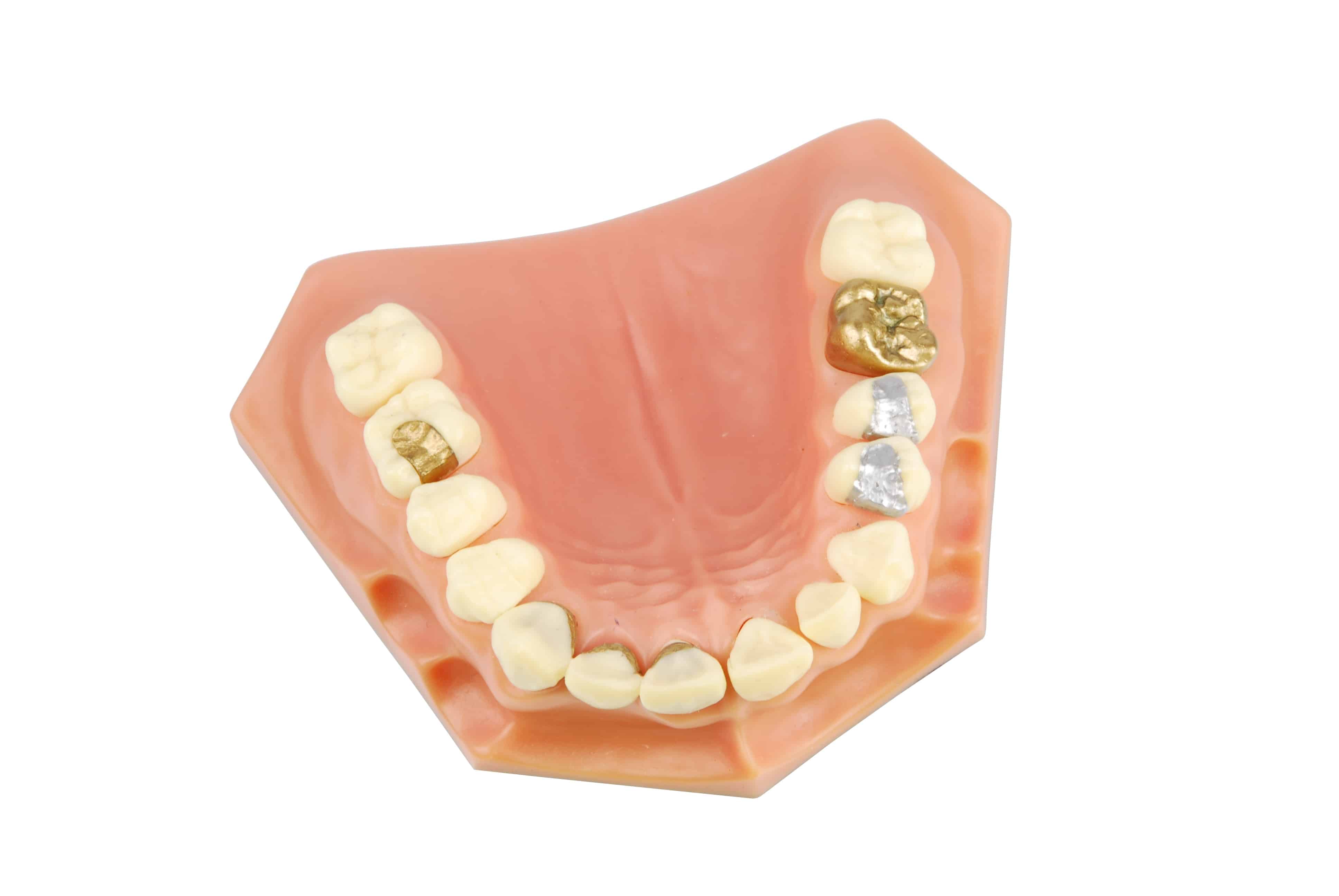 dental model showing different types of treatments (gold crown, porcelain veener, gold inlays, amalgam and composite fillings)
