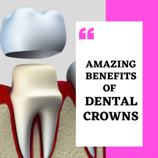 Amazing Benefits Of Getting Dental Crowns