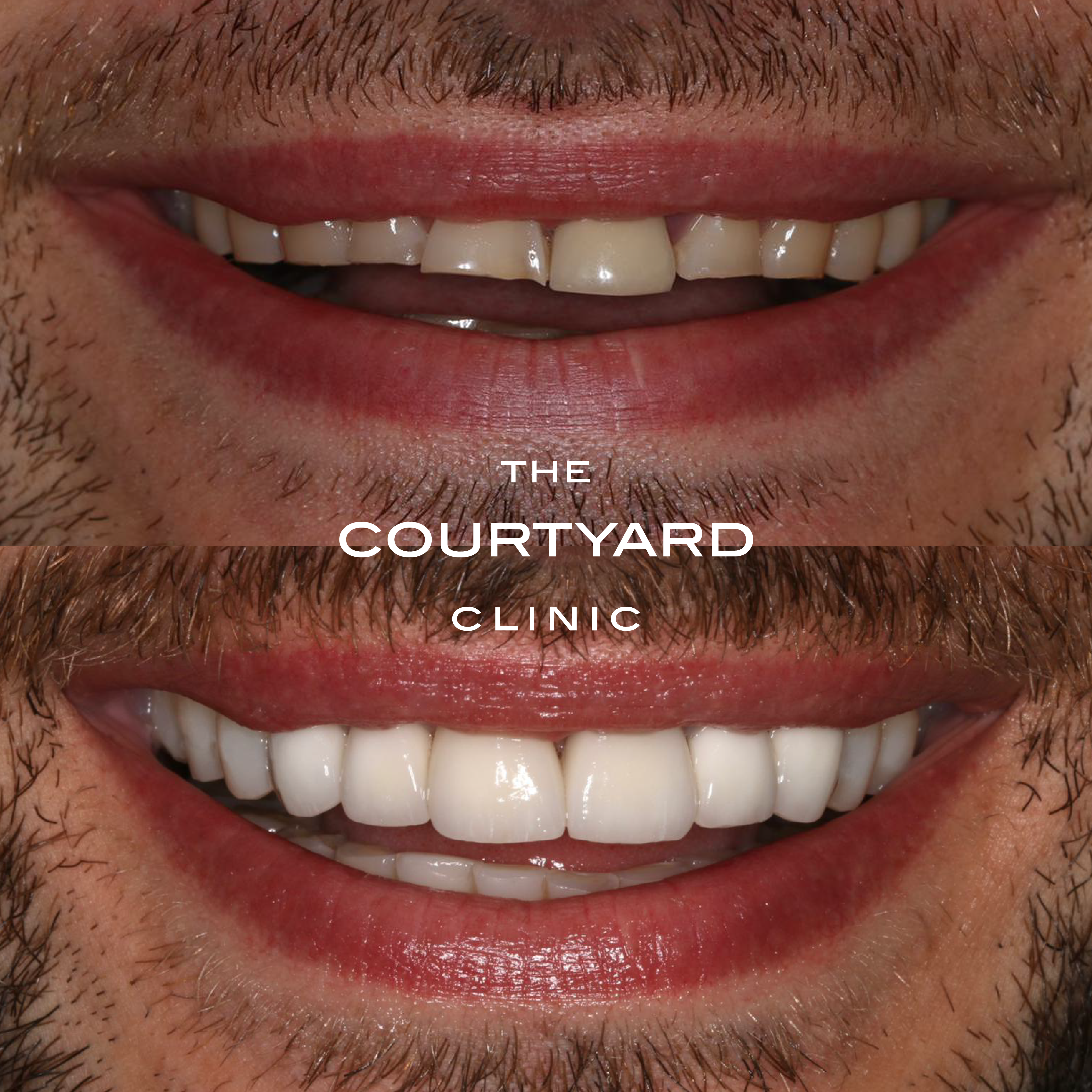 Before and After Veneers or caps -01